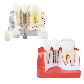 Dantų Demonstravimas Modelis Implantas Nuimamas Analizė Karūna Tiltas -Paciento Bendravimas